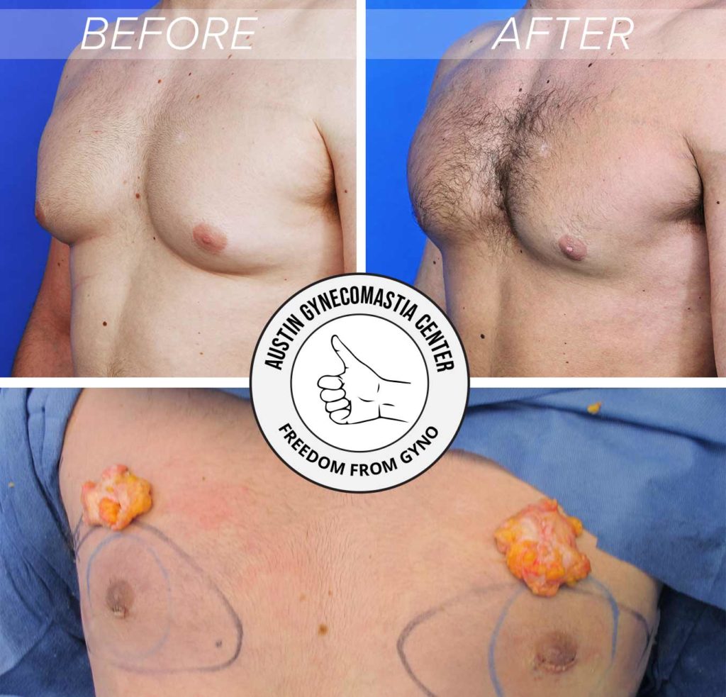 Before and after gynecomastia surgery including surgery showing gland removed