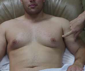 Male breast reduction patient lying down