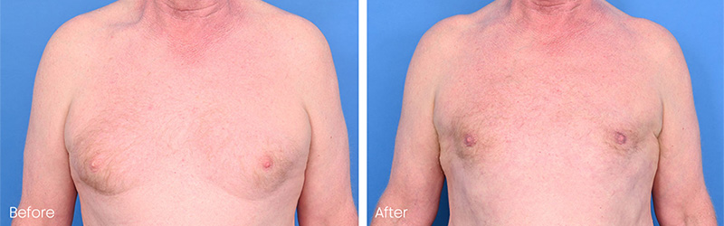 Affordable Gynecomastia Surgery