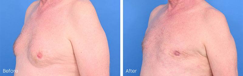 Affordable Gynecomastia Surgery