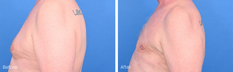 Affordable Gynecomastia Surgery