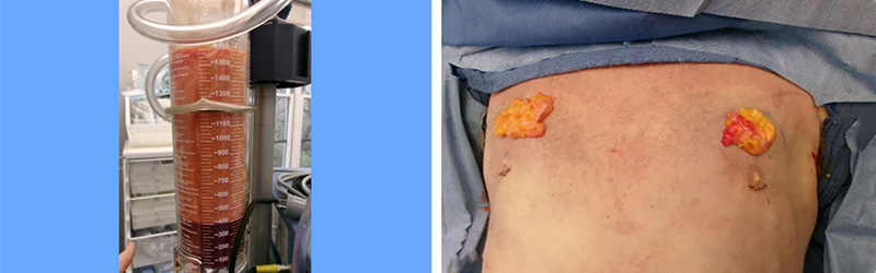 Affordable Gynecomastia Surgery