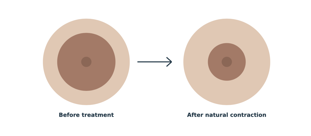 Diagram showing areola size before treatment and after natural contraction