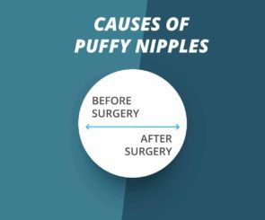 Cause of puffy nipples infographic