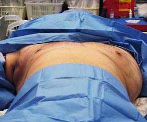 Person undergoing male breast reduction surgery