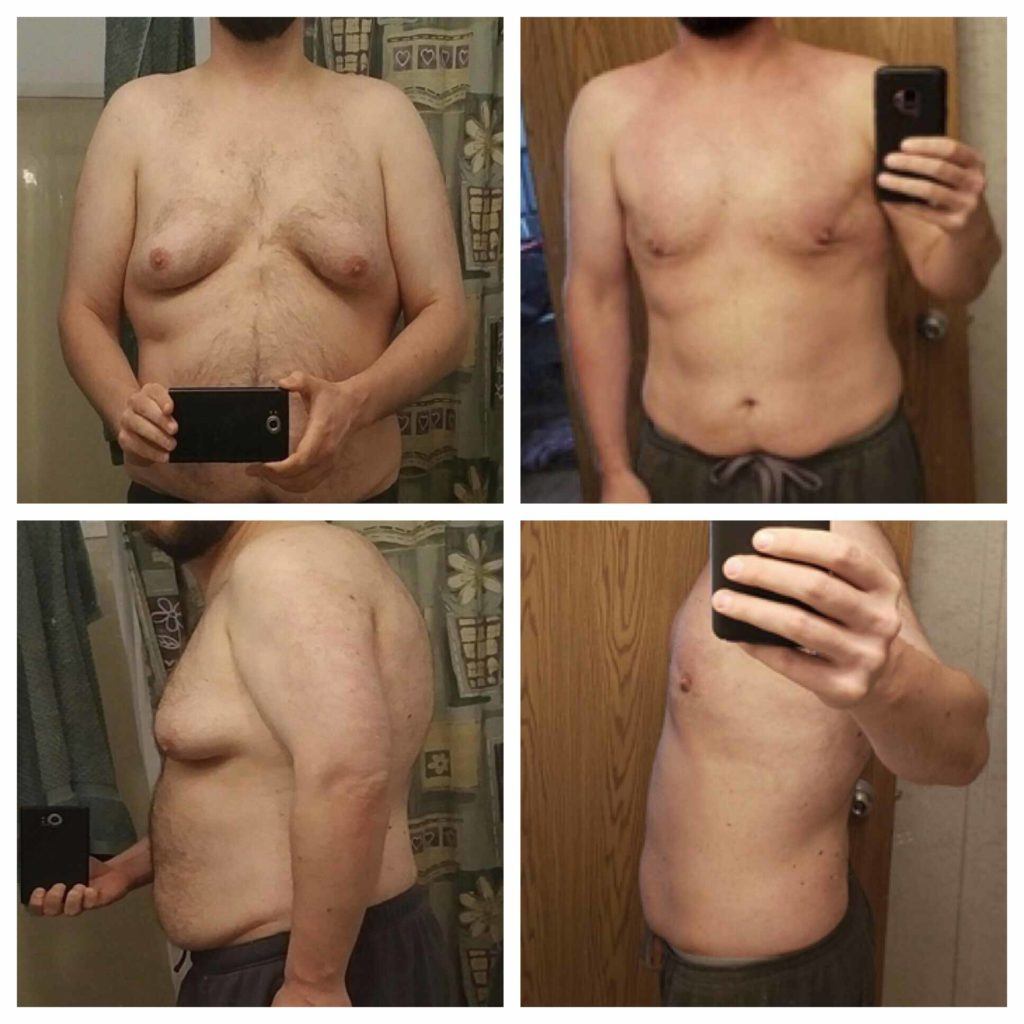 Excess skin before gynecomastia surgery - before and after photos