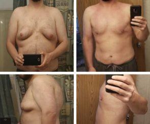Before and after Gynecomastia surgery