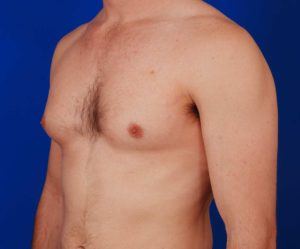 Gynecomastia patient model showing his torso