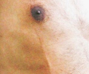 Mondors Disease on male chest