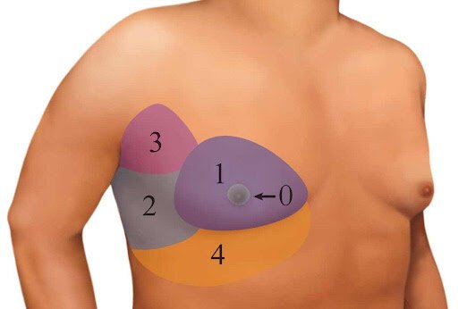 Zones for gynecomastia illustration