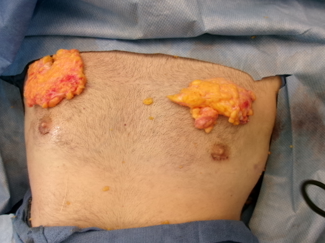 Gynecomastia patient results