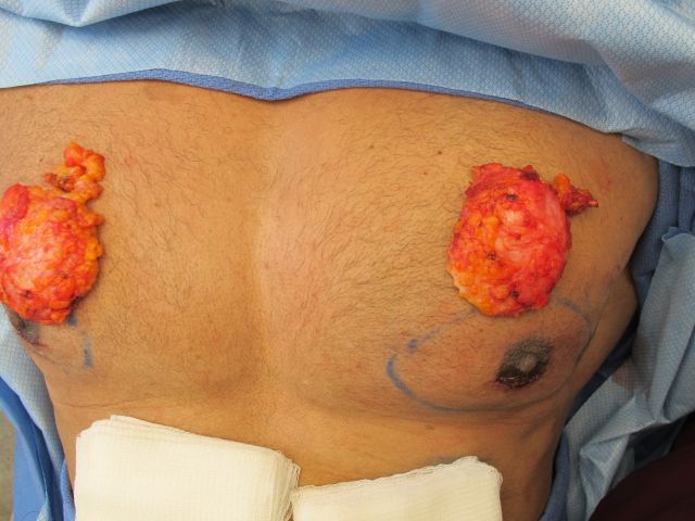 Gynecomastia patient results