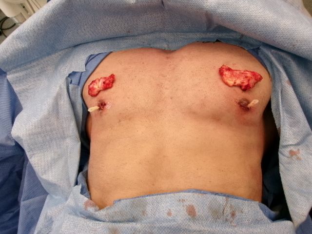 Gynecomastia patient results