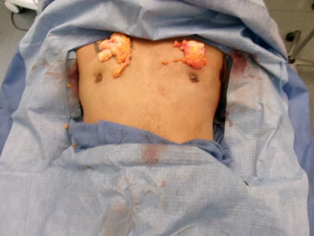 Gynecomastia patient results