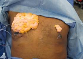 Glands removed during Austin Gynecomastia surgery