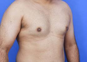 Austin Gynecomastia Surgery patient Before