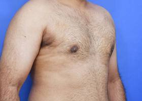 Austin Gynecomastia Surgery patient After