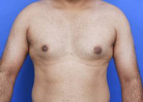 Austin Gynecomastia Surgery patient Before