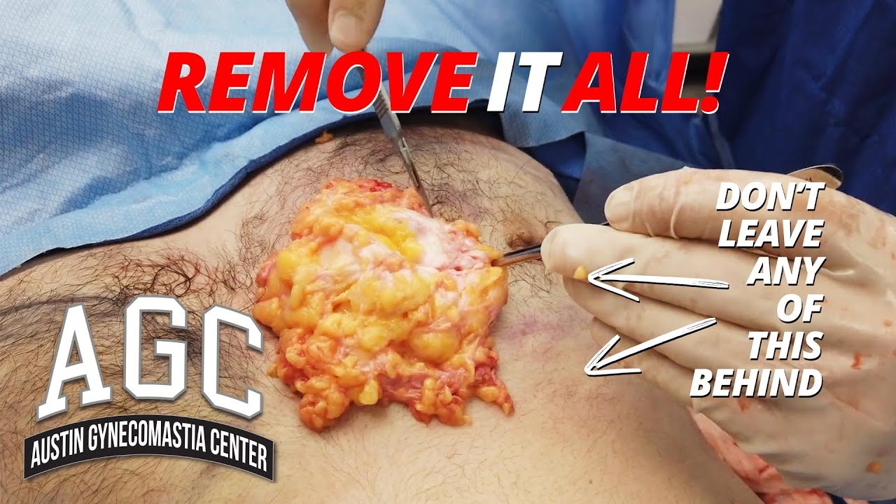 Removing breast tissue during gynecomastia surgery video