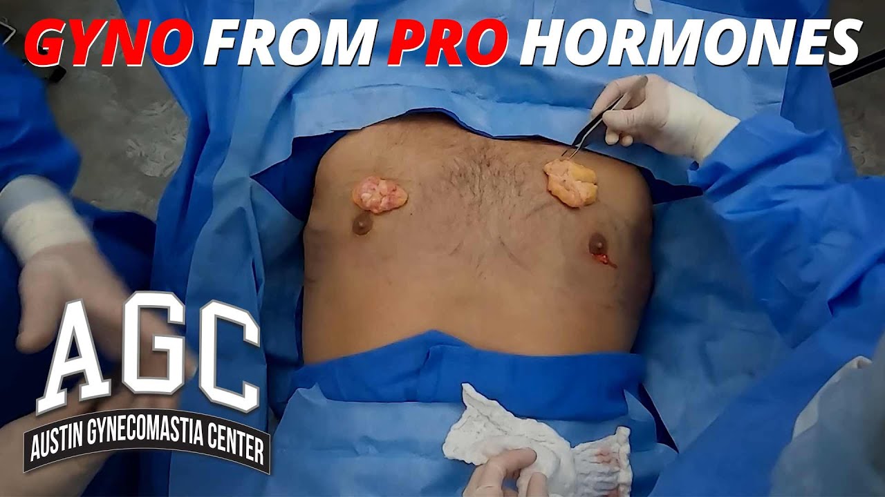 gynecomastia from horomones surgery video