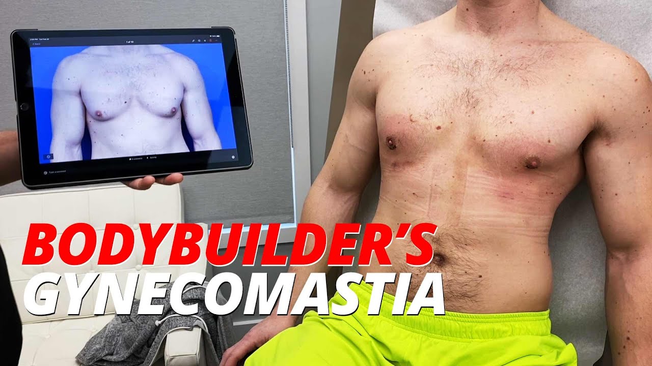 Bodybuilder's gynecomastia video