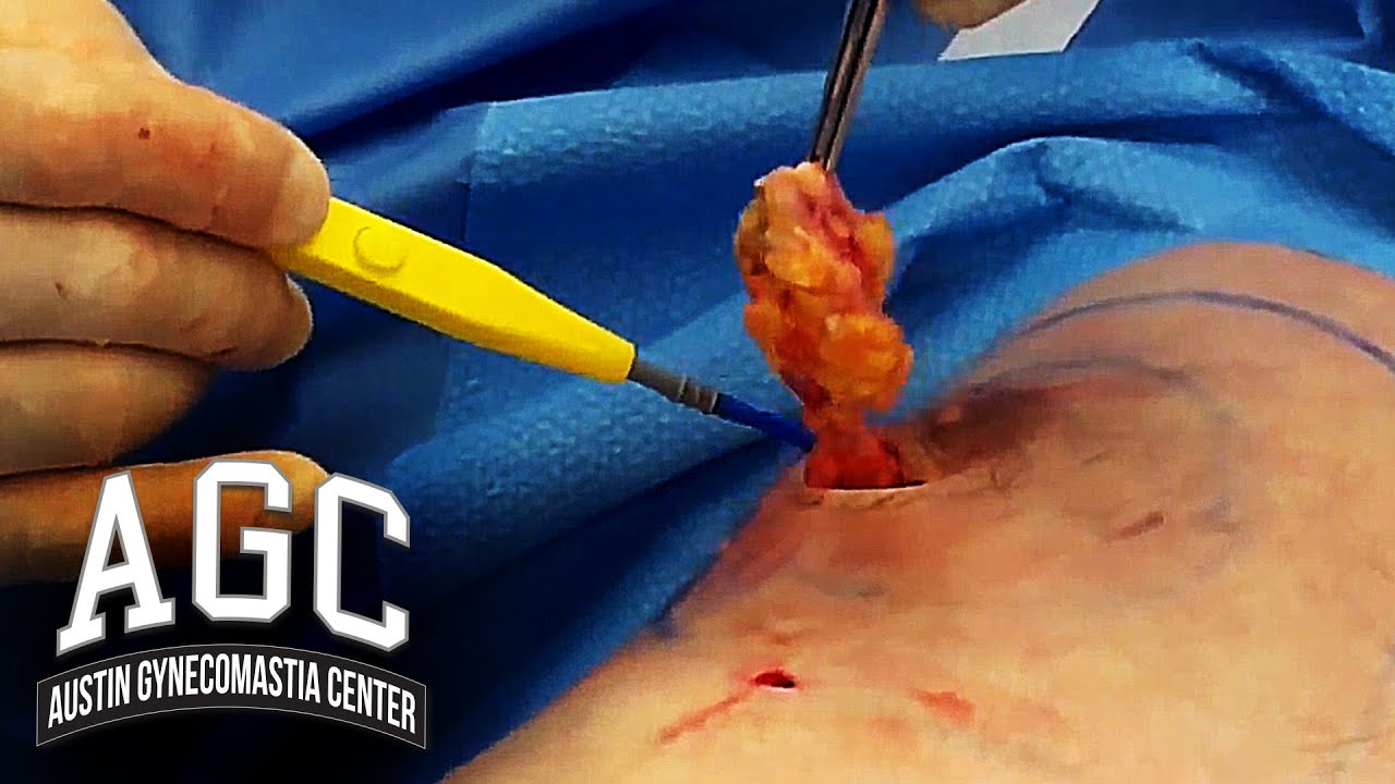 Gynecomastia surgery with waffle technique video