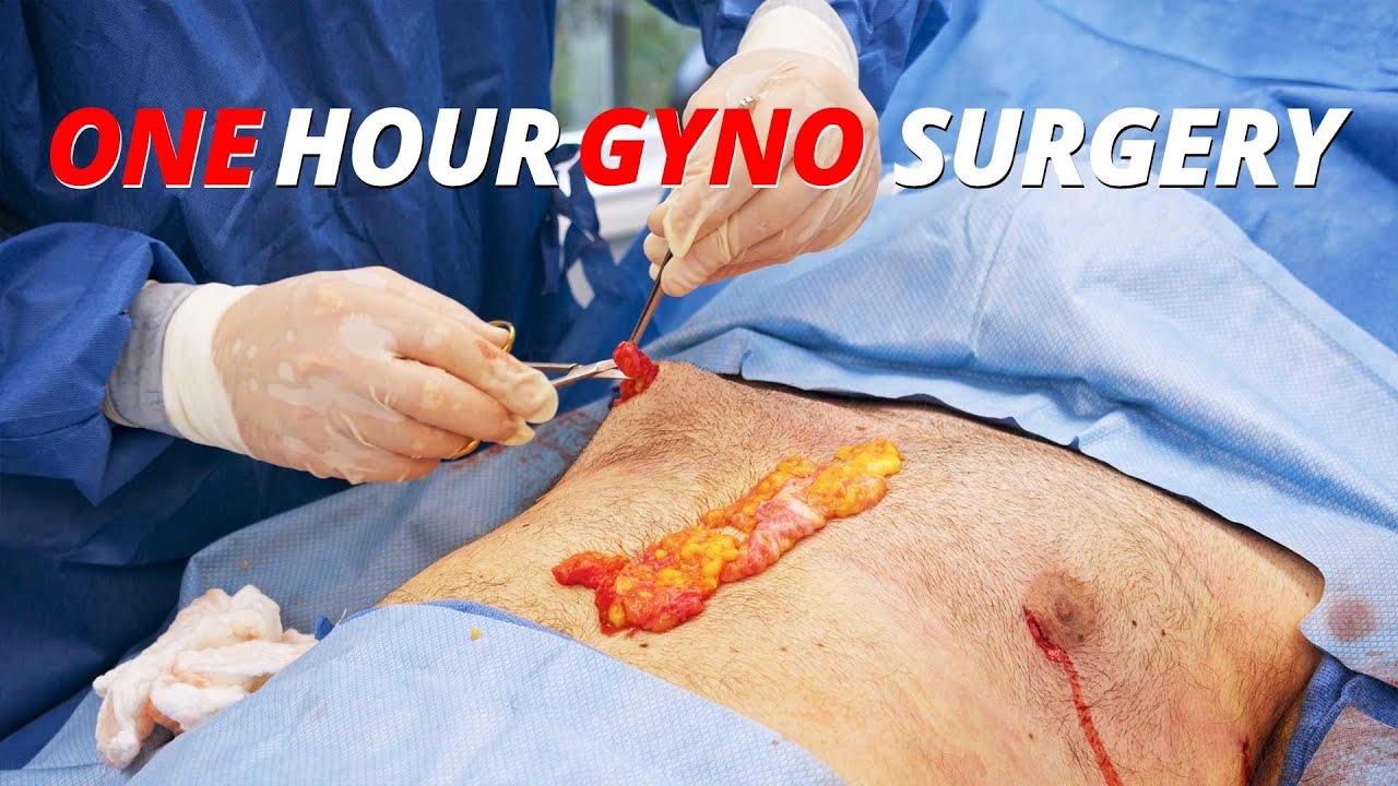 One hour Gynecomastia surgery video