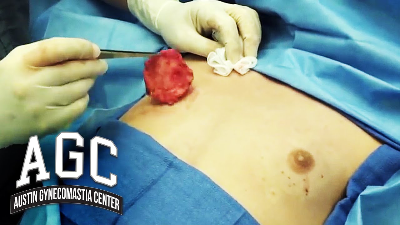 Gynecomastia removal in young patient video