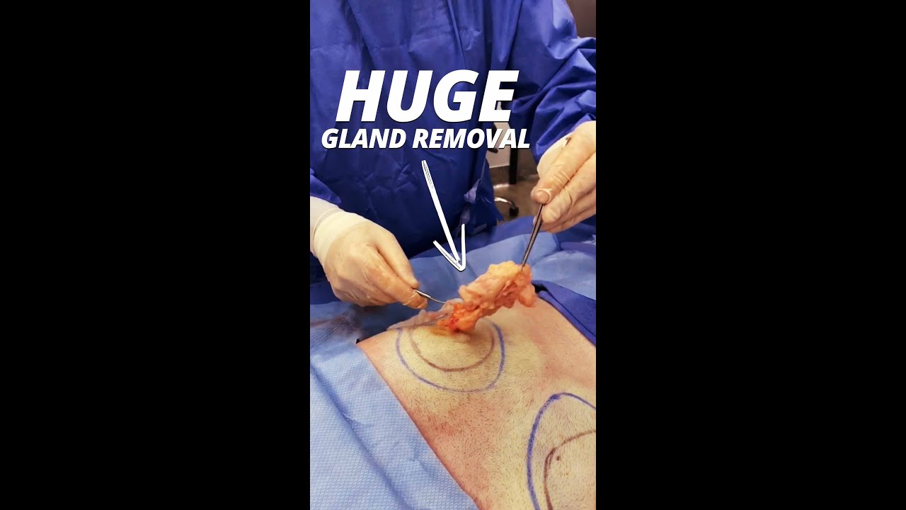 Gland removal during Gynecomastia surgery video