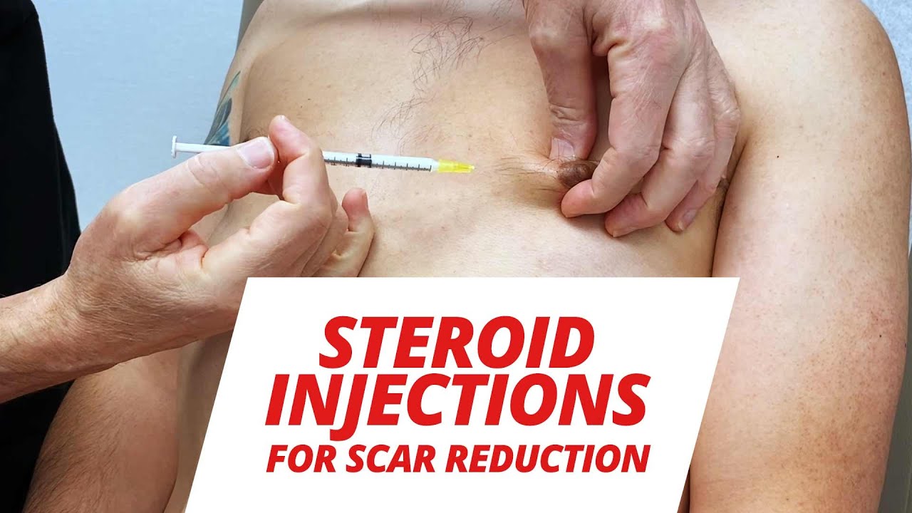 Steroid injection for scars video