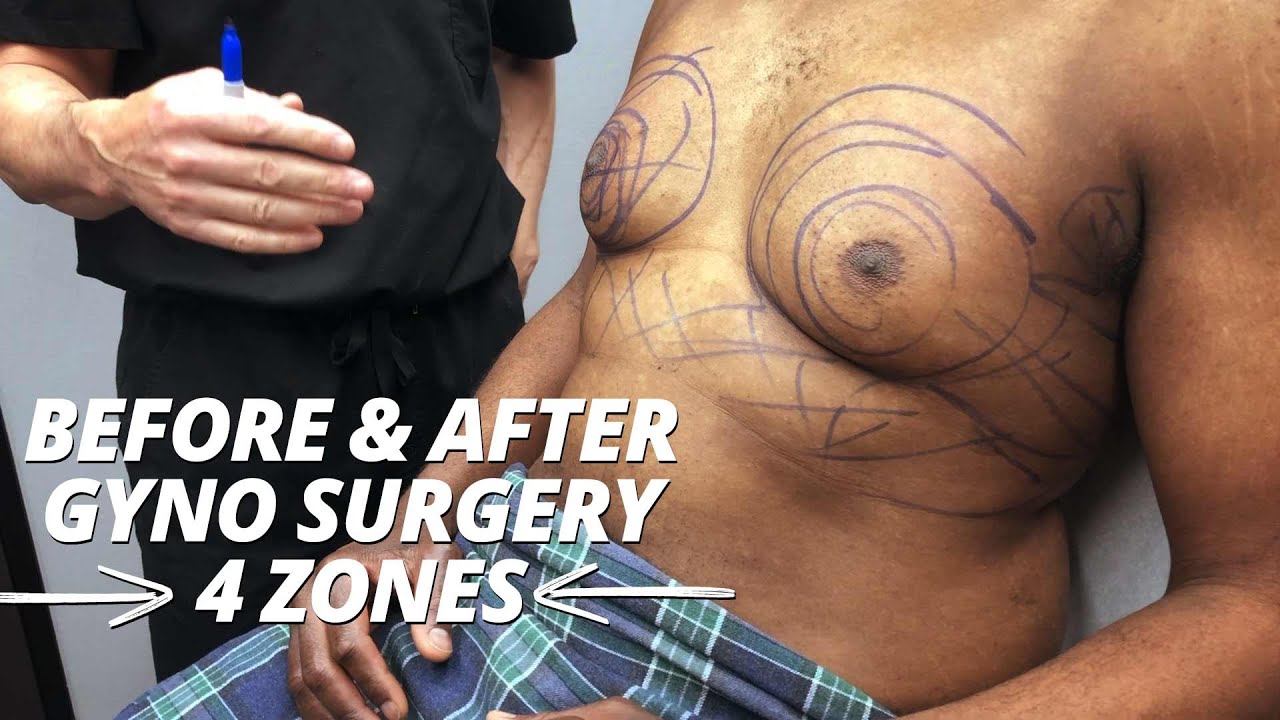 4 Zones before and after Gynecomastia surgery video
