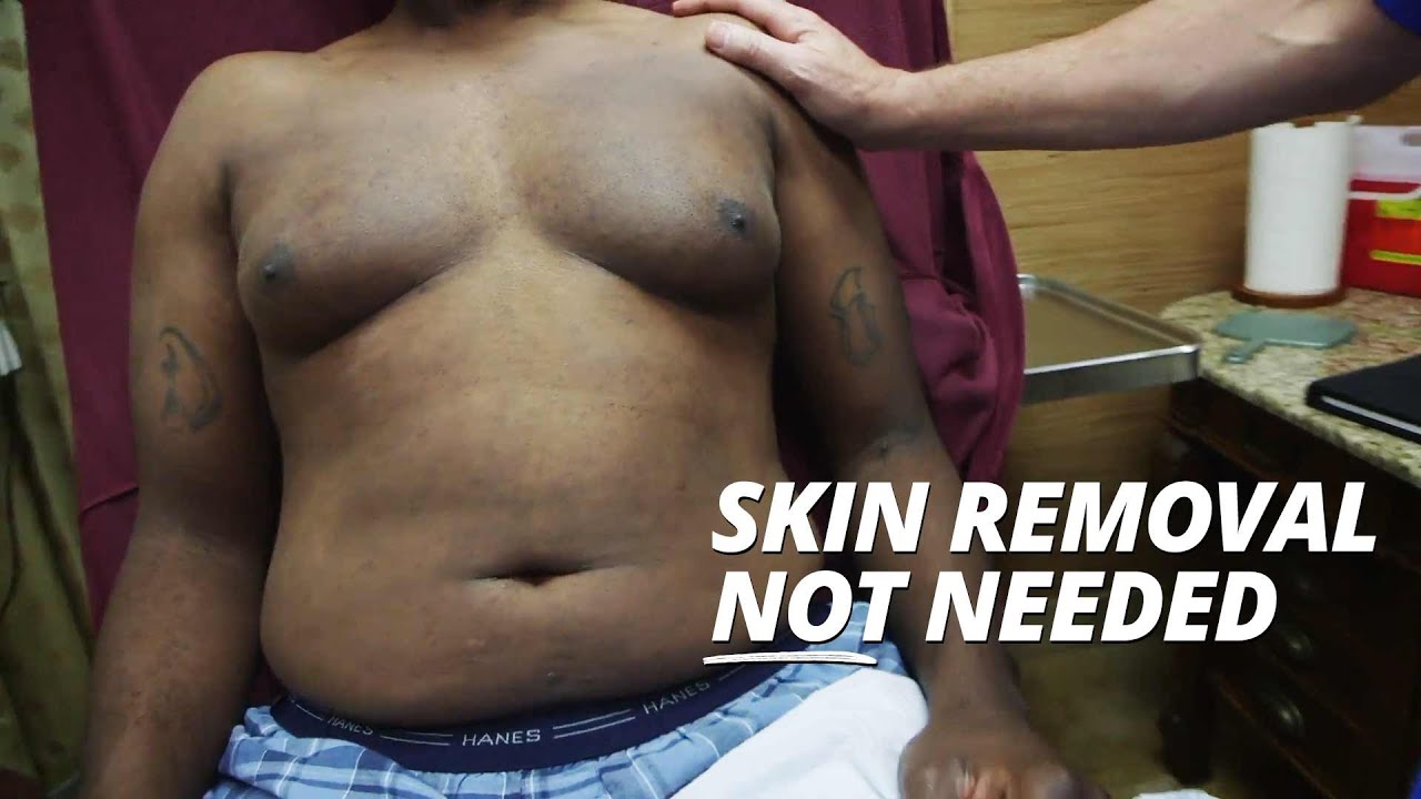 Skin removal not needed video