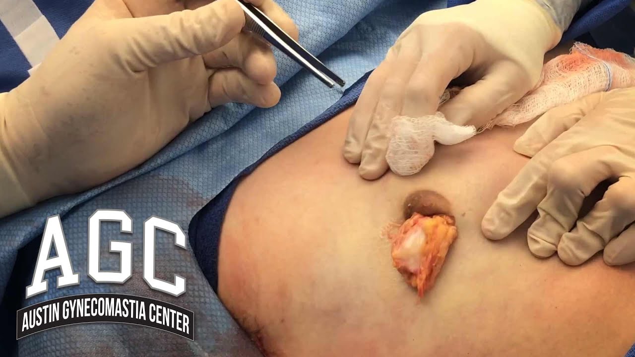 Removing tissue in Gynecomastia surgery video