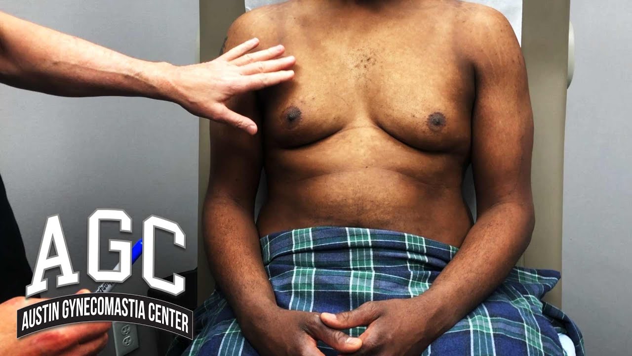 Gynecomastia patient being examined video