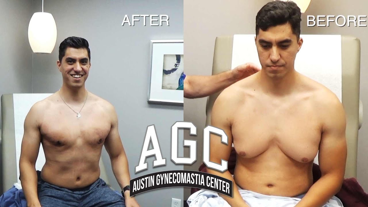 Before and after gynecomastia surgery patient video