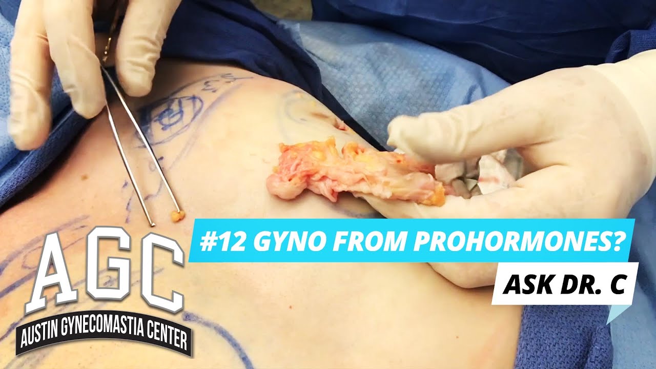 Gynecomastia from prohormones video