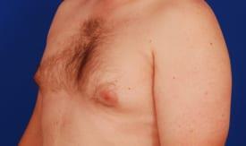Gynecomastia Surgery  Before & After Image