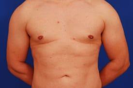 Gynecomastia Surgery Before & After Image