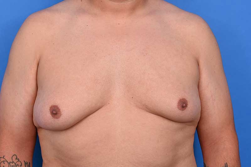 Gynecomastia Surgery Before & After Image