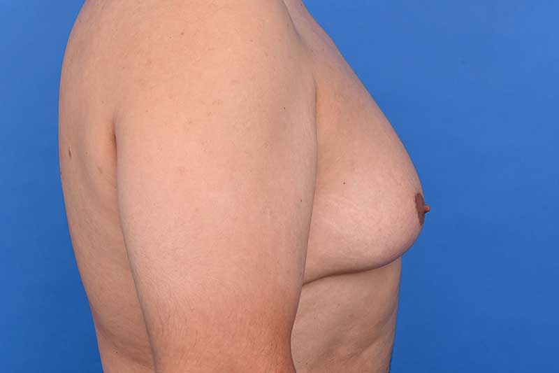 Gynecomastia Surgery Before & After Image