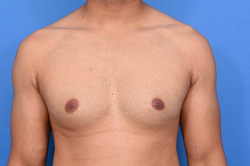 Gynecomastia Surgery Before & After Image