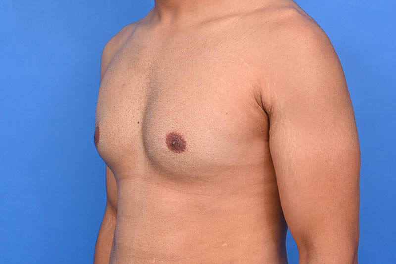 Gynecomastia Surgery Before & After Image