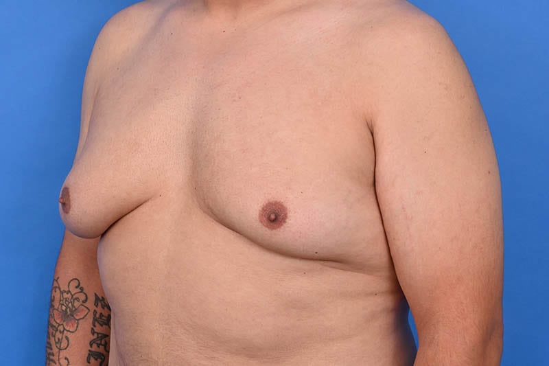 Gynecomastia Surgery Before & After Image