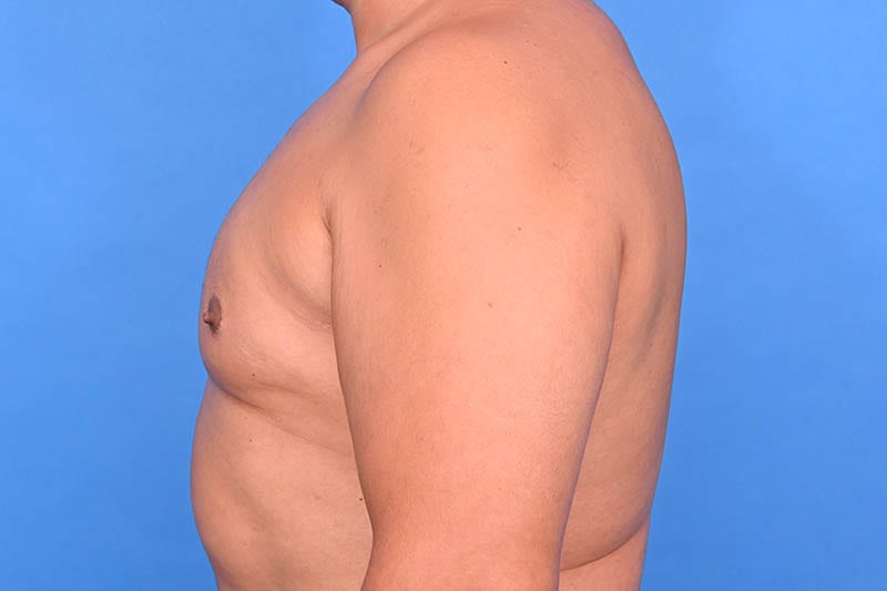 Gynecomastia Surgery Before & After Image