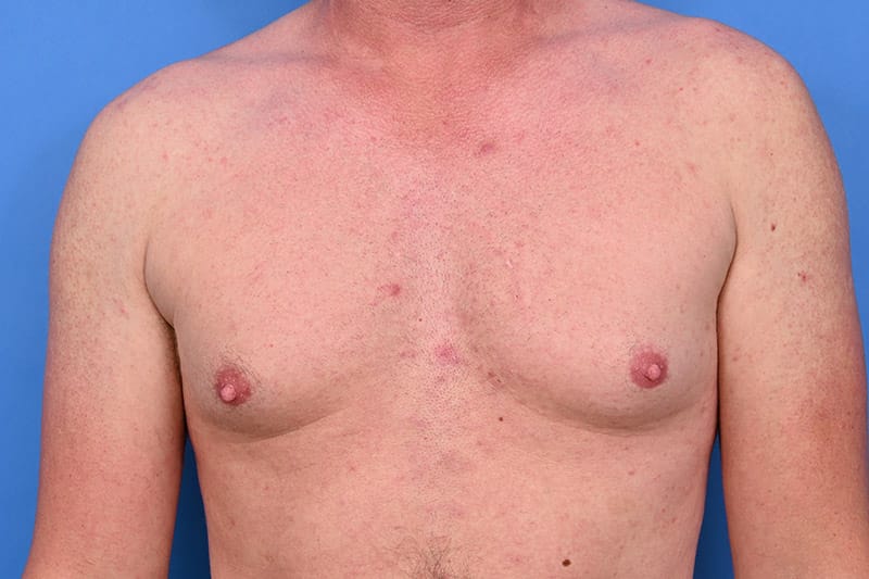 Gynecomastia Surgery Before & After Image