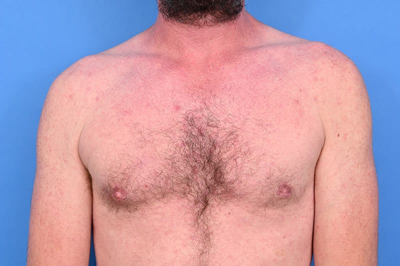 Gynecomastia Surgery Before & After Image