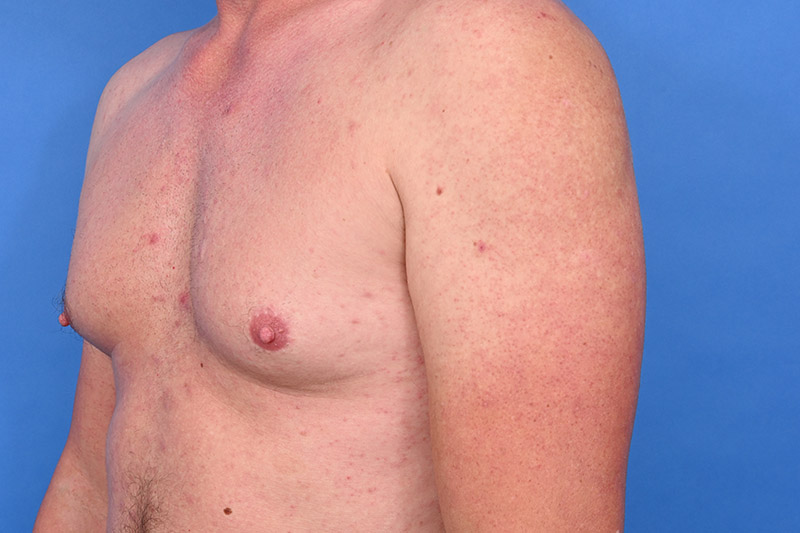 Gynecomastia Surgery Before & After Image