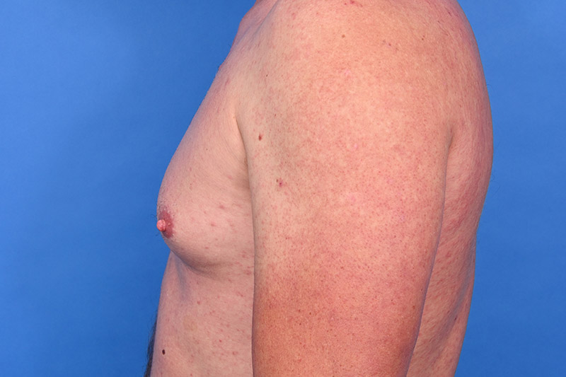 Gynecomastia Surgery Before & After Image