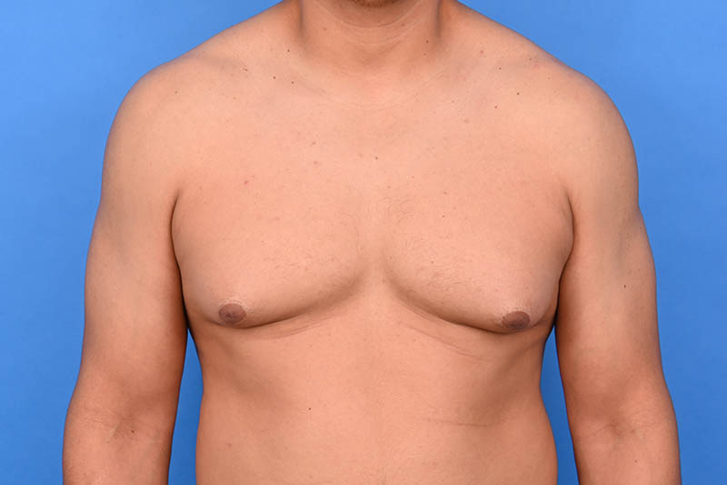 Gynecomastia Surgery Before & After Image