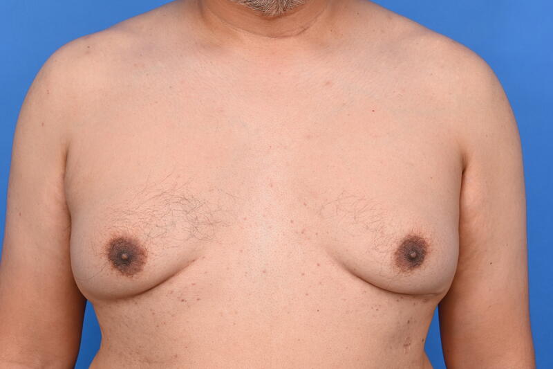 Gynecomastia Surgery Before & After Image